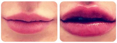 Lip Enhancement 